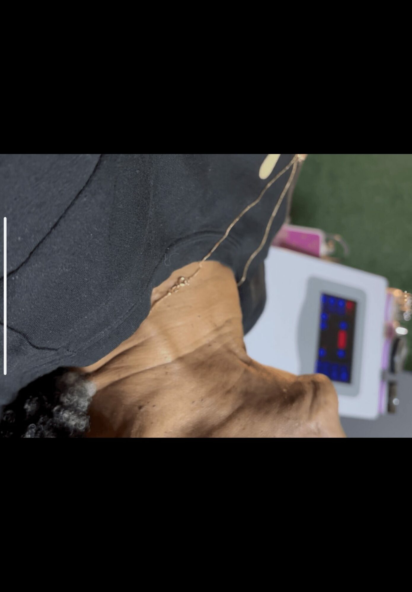 Close-up of a person's neck and shoulder with a medical device in the background.