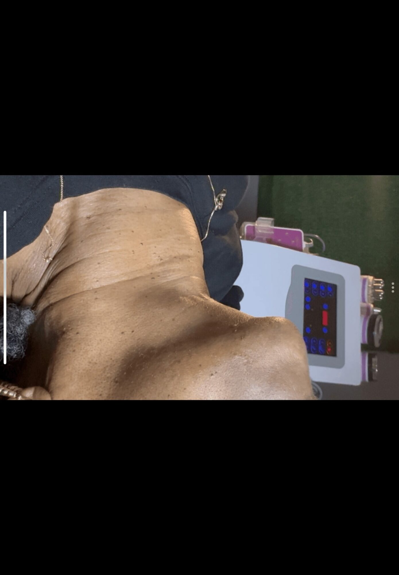 Close-up of a person's neck and chin with a medical device in the background, outdoors.