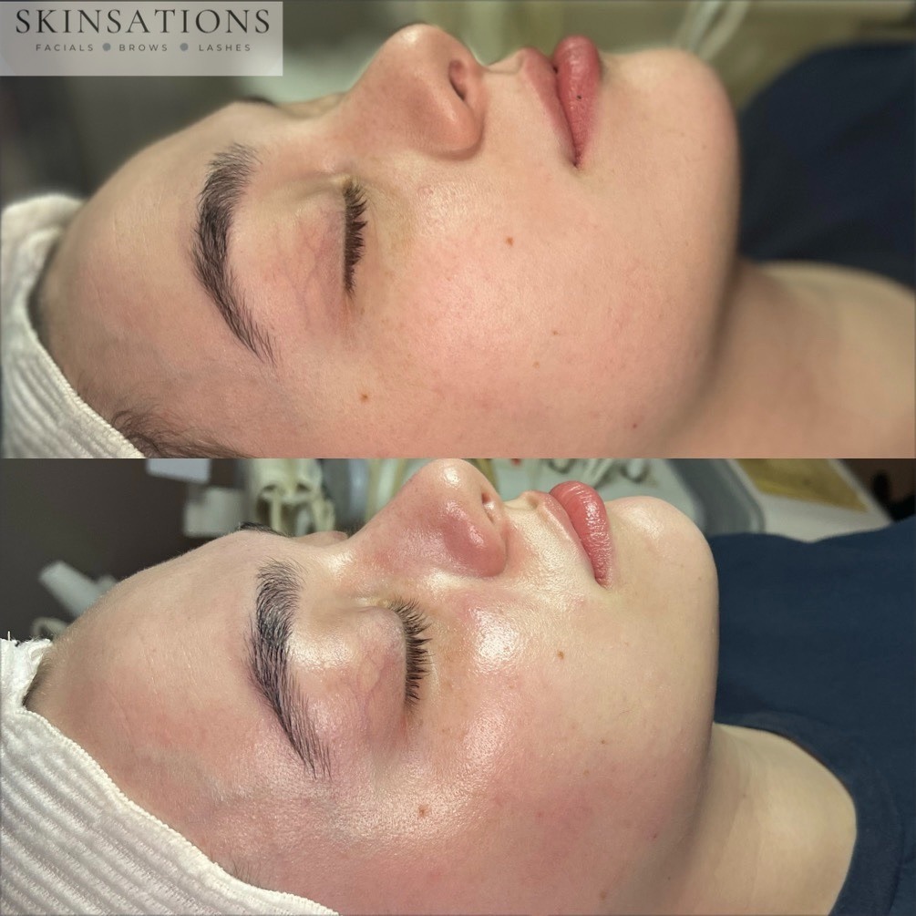 Side view of a woman's face with closed eyes, showing improved skin texture after treatment, with a headband and dark clothing.